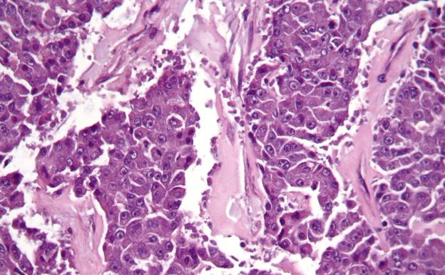 Carcinoma de células pancreáticas acinares./Creative Commons