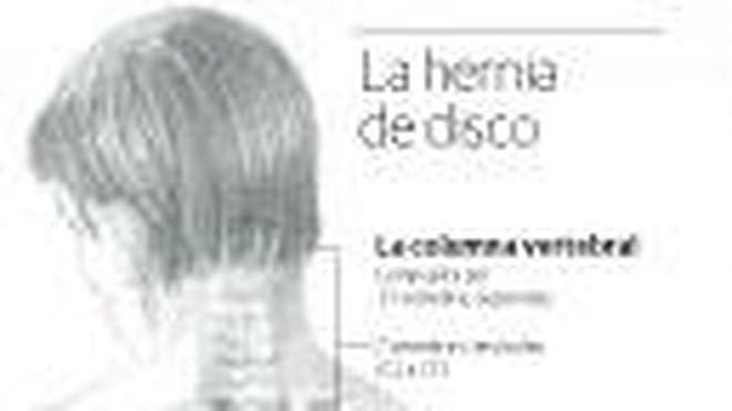 Hernia de disco sintomas graves